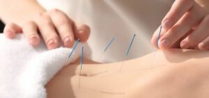 acupuntura