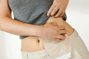Bolsa-de-colostomia-ostomia-estoma-1